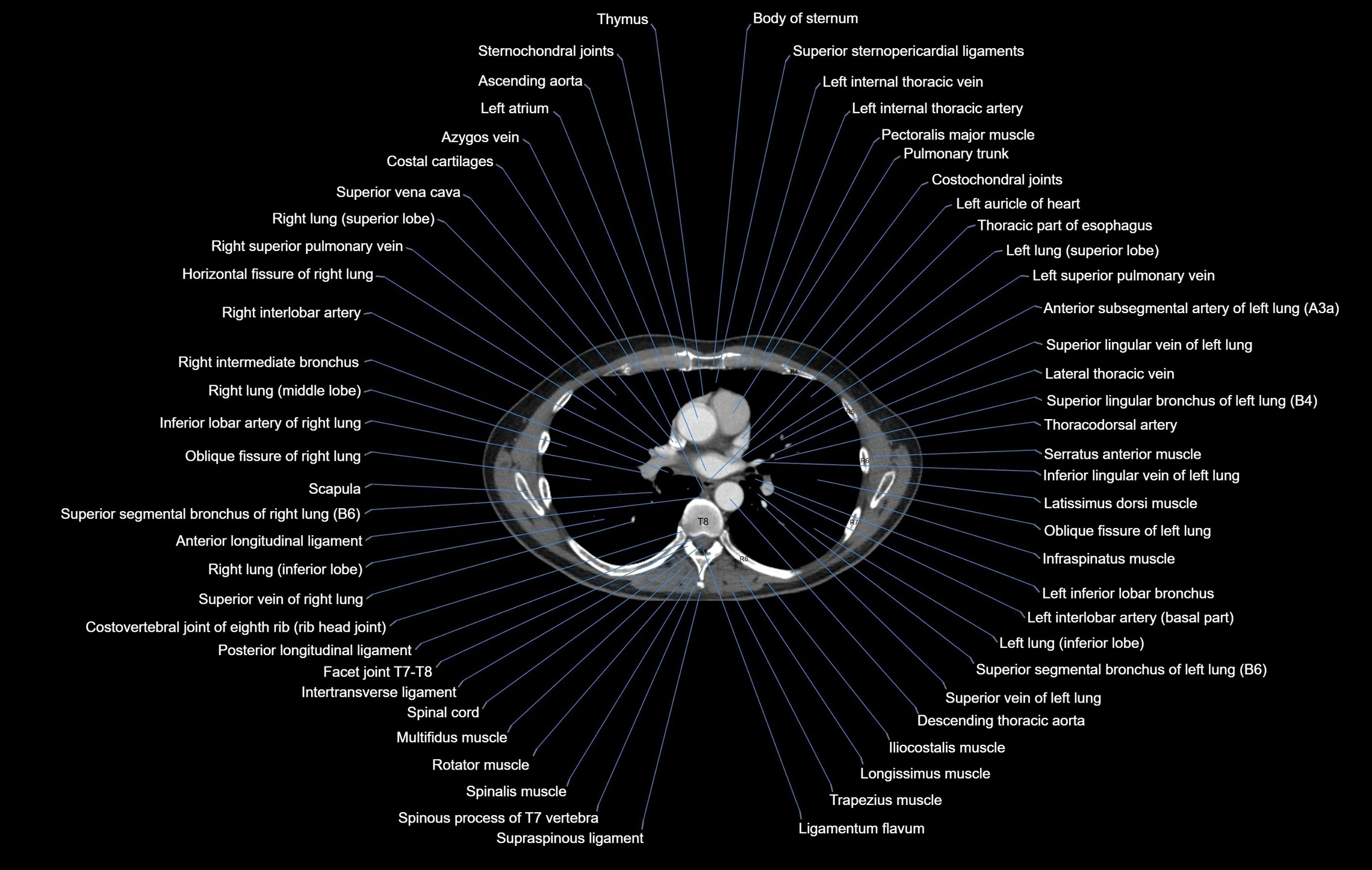 CT chest (thorax) labelled axial cross sectional anatomy radiology image-00062.webp